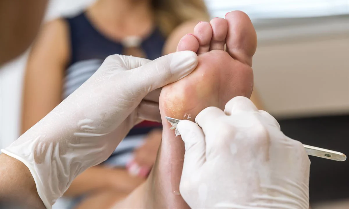 Tratamiento de callosidades y durezas