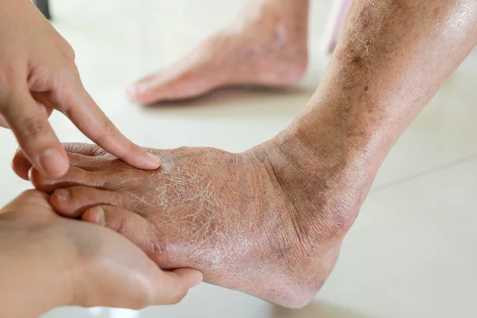 Atención especializada para pie diabético